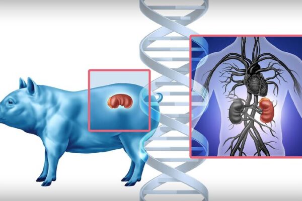 Chinese Doctors Transplant Pig Kidney into Human Patient, Offering New Hope Pig-to-human kidney transplant in China offers hope to millions