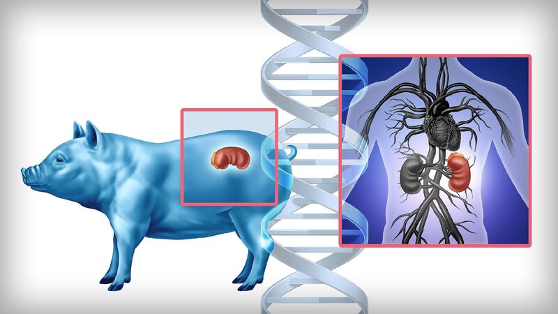 Pig-to-human kidney transplant in China offers hope to millions