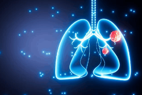 Study Shows How Air Pollution Can Cause Lung Cancer in Nonsmokers Study links air pollution to more lung cancer mutations in nonsmokers