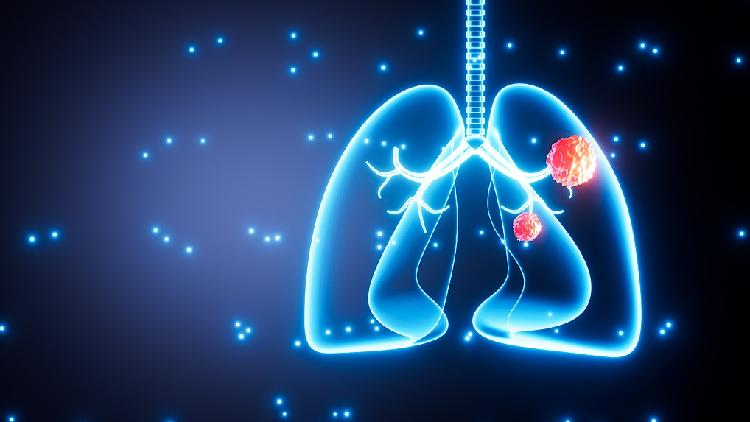 Study_links_air_pollution_to_more_lung_cancer_mutations_in_nonsmokers - My Global News: Young Voices Study links air pollution to more lung cancer mutations in nonsmokers